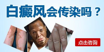 白癜风会传染吗？