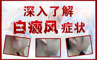 白癜风临床症状有哪些，你了解多少？