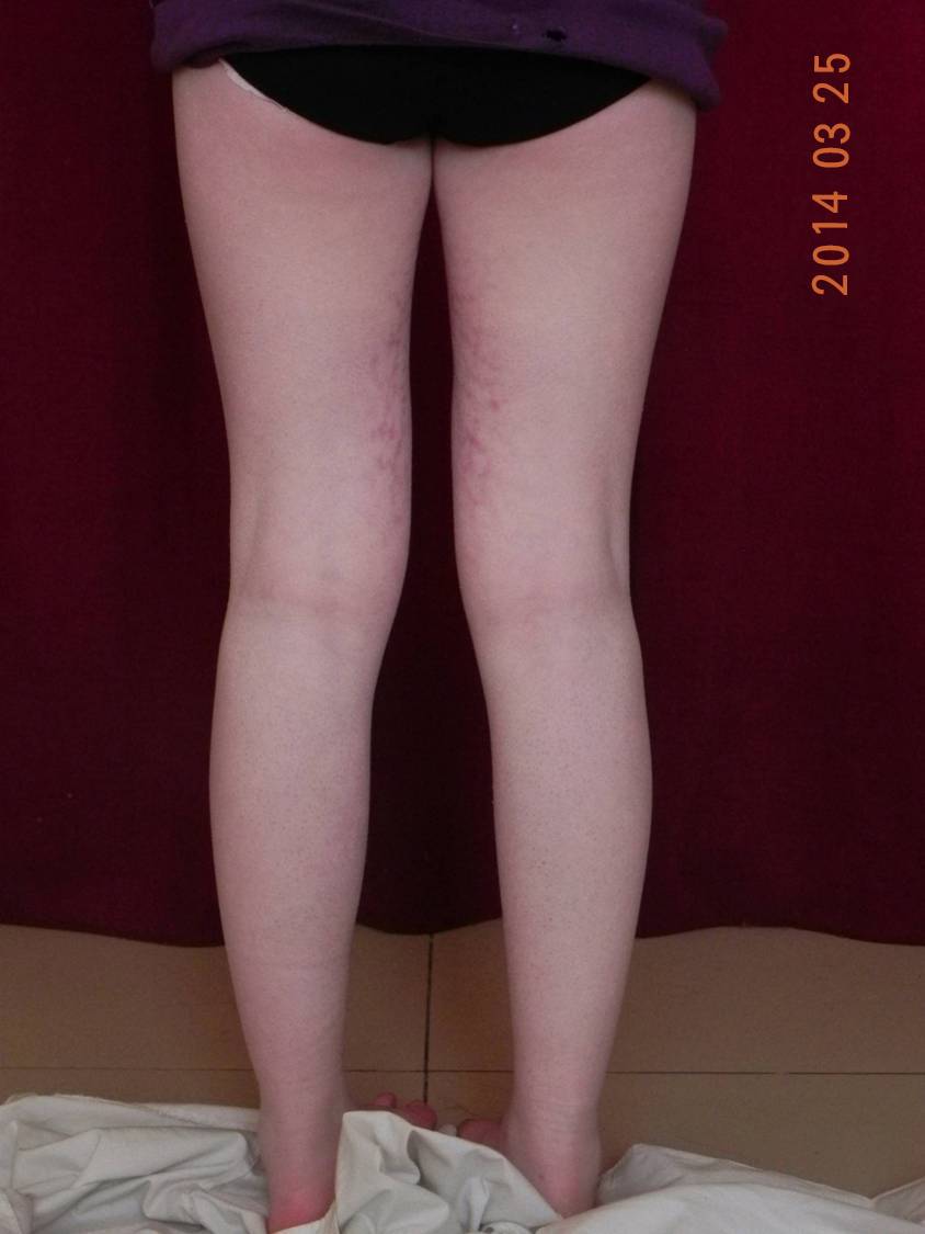 白癜风病情严重时能治好吗