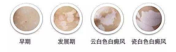 白癜风初期症状是什么样子？