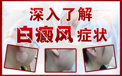白癜风早期症状有哪些？