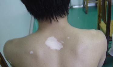 你了解白癜风的症状吗？