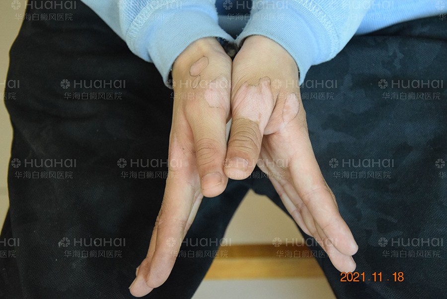 儿童双手白癜风治疗