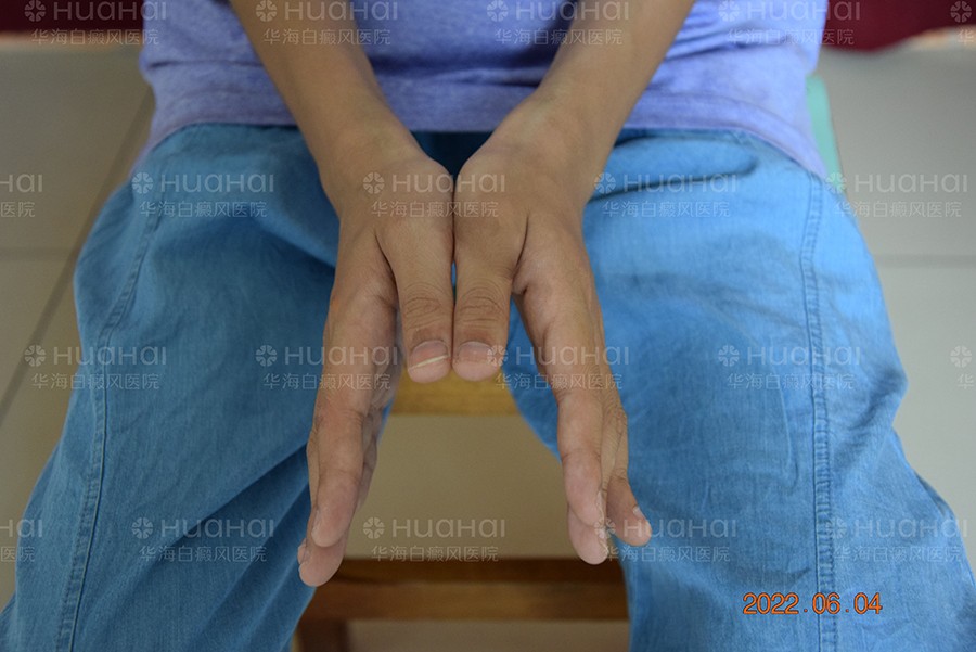 儿童双手白癜风治疗