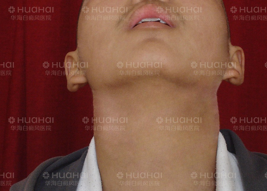 学生颈部白癜风治疗