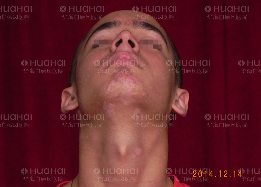 南非白癜风患者哈萨